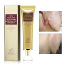 LANBENA Pimple Scar Acne Mark Spots Removal Treatment Gel Ointment Blemish Cream