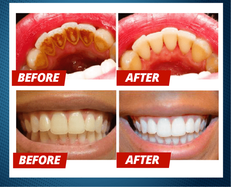Intensive Stain Removal Teeth Whitening Toothpaste Bleeding Gums Passion Fruit